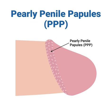 papule penienne|Pearly Penile Papule